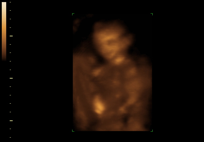 3D ultrasound image at 17 weeks